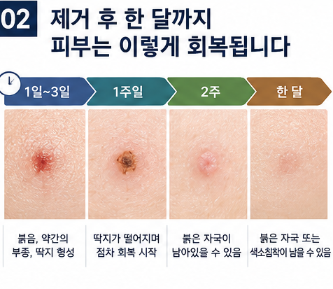 비립종 쥐젖 편평사마귀 제거 후 한 달, 다시 올라오는 이유와 재발 시기 빨간자국 색소침착....