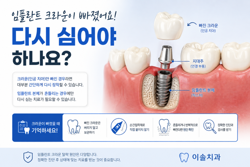 양평, 청평 임플란트 크라운이 빠졌어요, 다시 심어야 하나요?