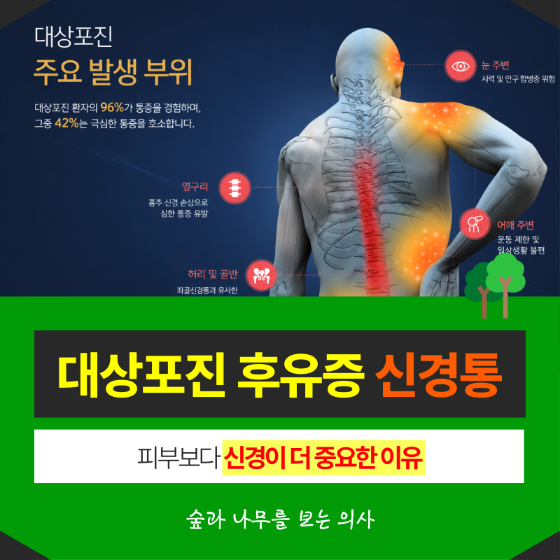 대상포진 후유증 신경통 피부보다 신경이 더 중요한 이유