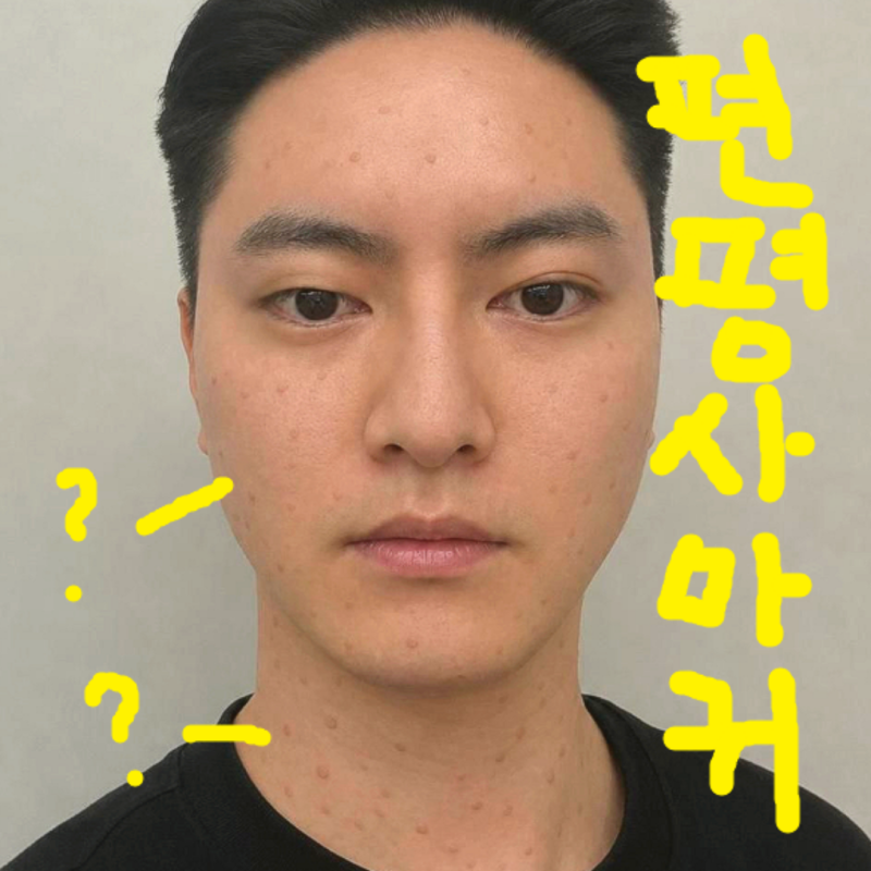천안편평사마귀제거 알아볼 때 참고할 원인·치료·관리법