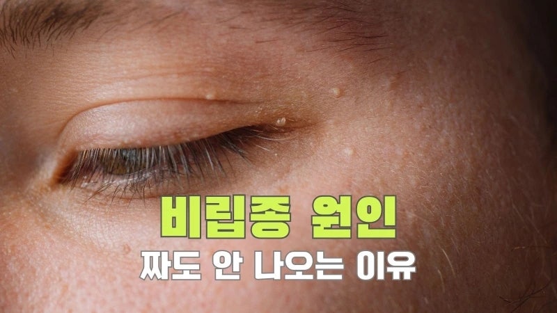 비립종원인부터 비립종제거까지, 짜도 안 나오는 이유와 비립종연고의 진실