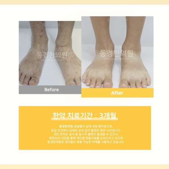 노인성 자반증, “부모님 팔에 번져가는 반점” 그냥 두지 마세요.