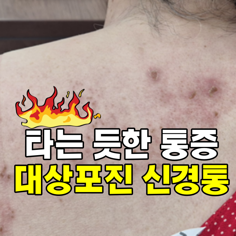 대상포진 신경통 타는 듯한 통증 벌레기어가는 느낌이 느껴진다면 치료방법