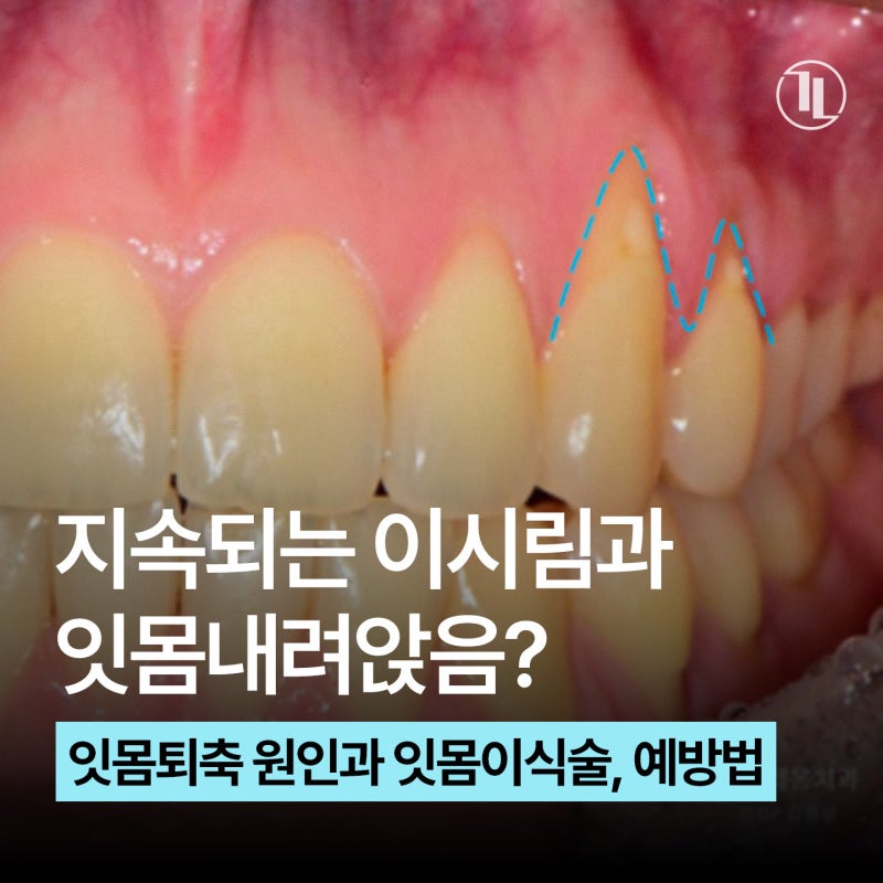 잇몸내려앉음과 이 시림, 잇몸퇴축 / 원인부터 치료 방법까지 총정리 / 강남레옹치과