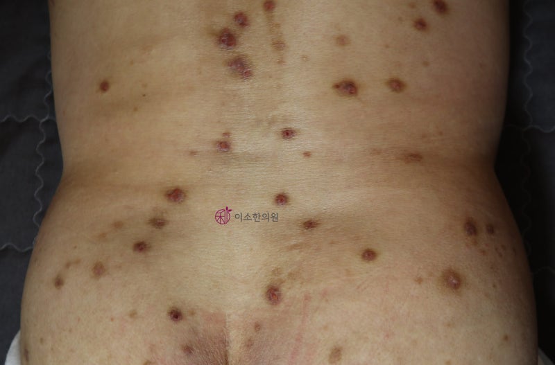 결절성 양진, 극심한 가려움 딱딱한 몽우리 특징과 관리법, 치료 원칙