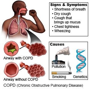 만성폐쇄성폐질환 COPD chronic obstructive pulmonary disease