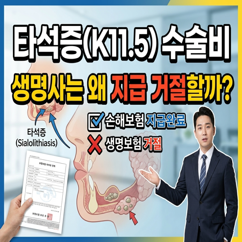 침샘에 돌이? 타석증(K11.5) 완전정복 & 수술비 보상 안내