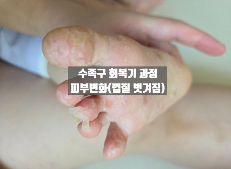 아기 수족구 회복기 과정 : 수포 변화부터 껍질 벗겨짐(탈각), 등원확인서 발급 시기 총정리