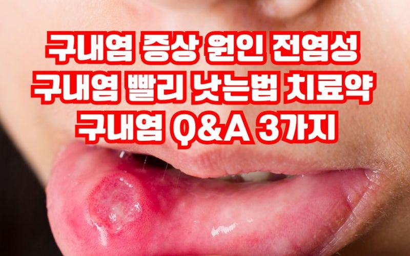 구내염 증상 원인 전염성 치료약 구내염 빨리 낫는법 Q&A 3가지