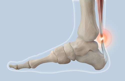 아킬레스건염(Achilles tendinitis) 정의, 원인 및 치료법! [부전역 정형외과 질환 설명]