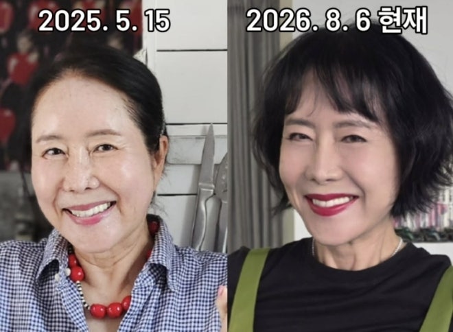 윤영미도 받은 안면거상술 뭐길래? 50·60대 관심 커진 이유...일반 리프팅 차이는?