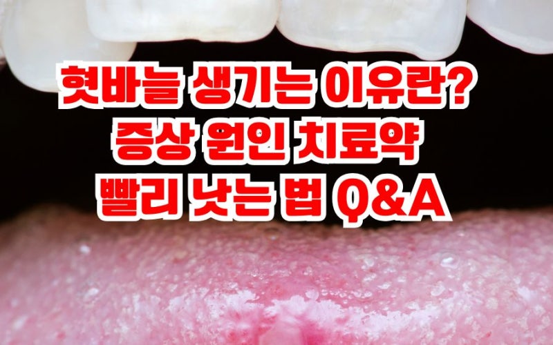 혓바늘 생기는 이유 증상 원인 치료약 빨리 낫는 Q&A