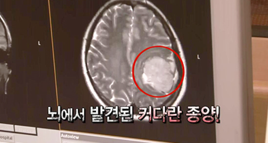 갑자기 머리가 터질 듯이 아프다면? 뇌종양 뇌압 상승 증상 상관관계
