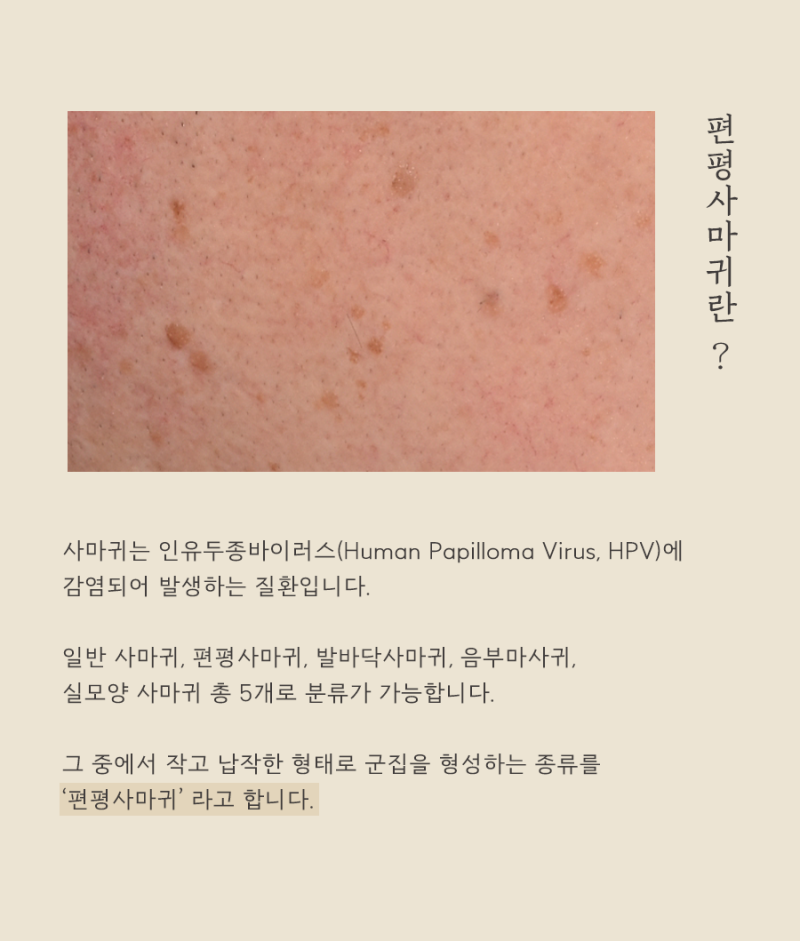 편평사마귀, 왜 생기고 어떻게 치료해야 할까요?