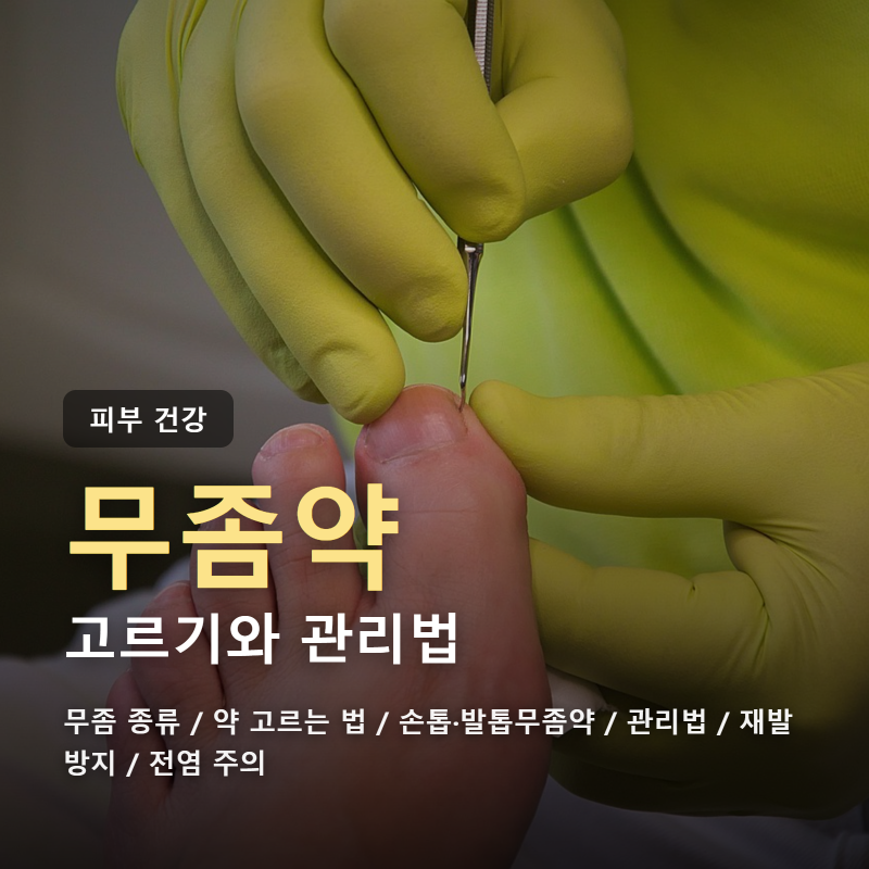 무좀약추천과 효과 높이는 관리법, 손톱무좀약·발톱무좀약 총정리