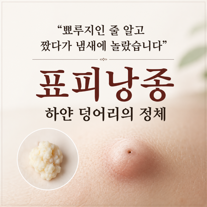 "뾰루지인 줄 알고 짰다가 냄새에 놀랐습니다" 표피낭종 하얀 덩어리의 정체