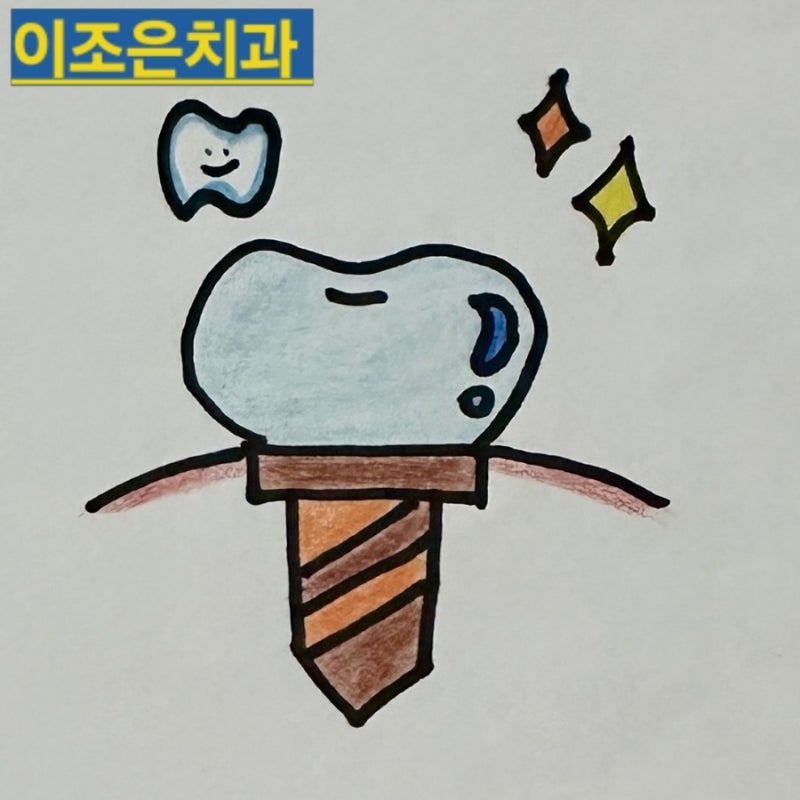 부평임플란트 임플란트 가격이 저렴한 치과가 좋을까요?