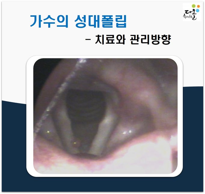 (가수 성대폴립) 가수 목소리가 갑자기 안 나오는 이유, 오래된 발성이 문제일까요?