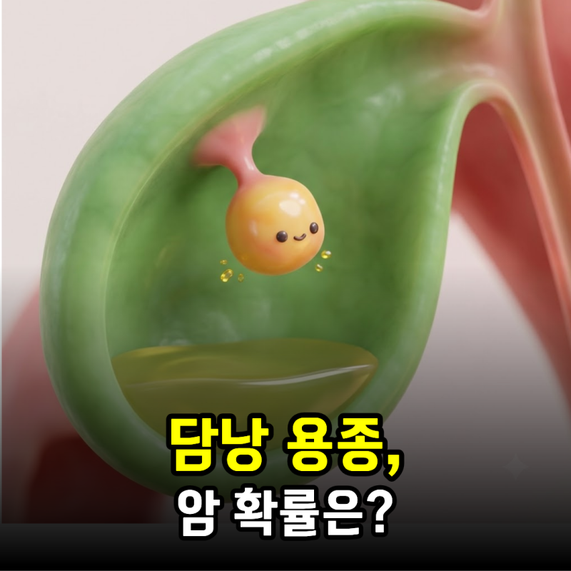 담낭 용종, 암 확률은?