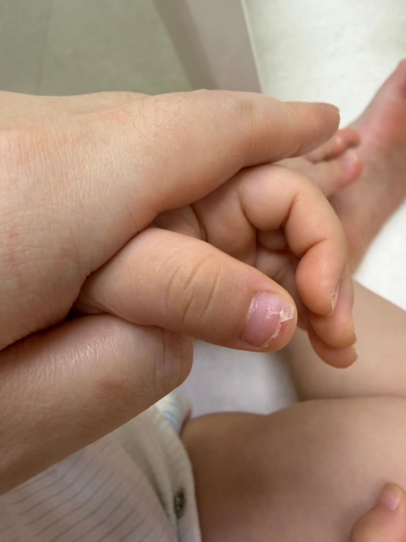 아기 손톱이 깨지고 발톱이 빠지려 해서 병원 다녀왔어요｜수족구 후 조갑탈각