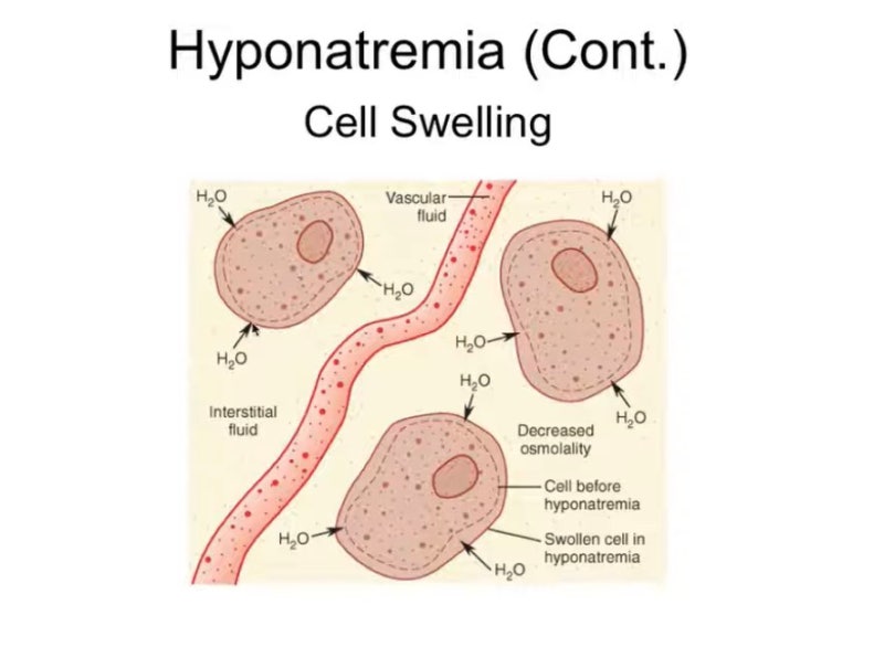 Hyponatremia (미완성)