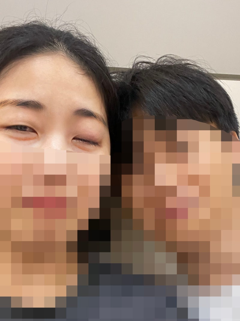 눈콩다래끼 5개월만에 째기, 수술후기 통증 흉터 비용 주의사항