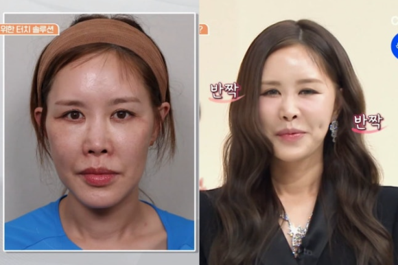 채리나 쌍꺼풀 수술 부작용 고백…“한쪽 눈 구축, 카메라 정면 보기 싫었다”