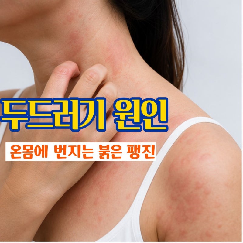"사라졌다 다시 올라온다면" 두드러기원인과 치료법