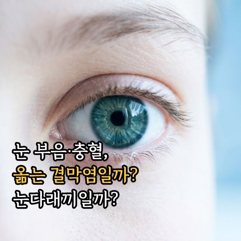 결막염증상 및 결막염전염 주의: 유행성 각결막염과 눈다래끼 다래끼 차이