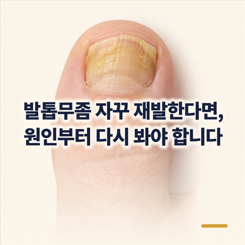 발톱무좀 어떻게 치료하면 좋을까?