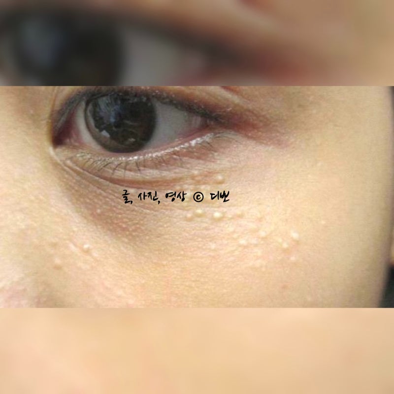 눈비립종 눈가에 오돌토돌 생겼다면? 비립종 원인부터 관리 방법까지