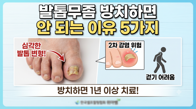 발톱무좀 방치하면 안 되는 이유 5가지