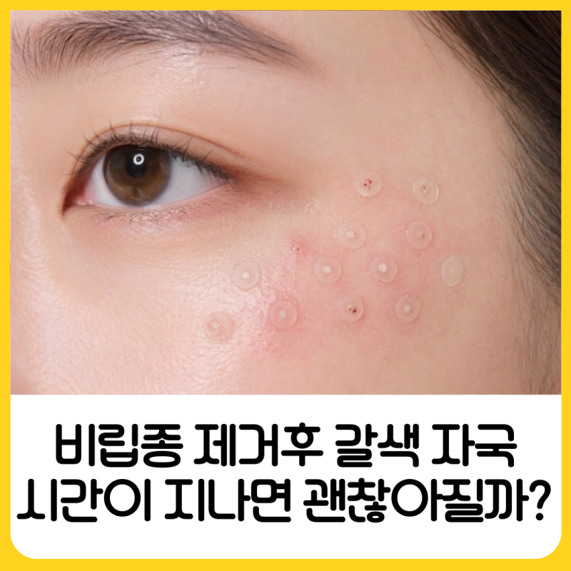 비립종 제거 후 색소침착일까? 눈밑 자국 비립종 제거 후 관리