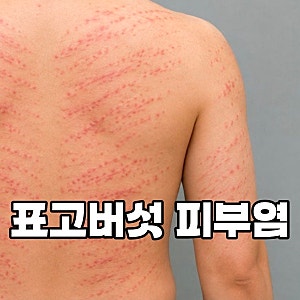 표고버섯의 채찍질, 표고버섯 피부염