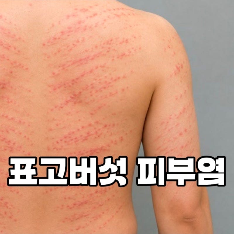 표고버섯의 채찍질, 표고버섯 피부염