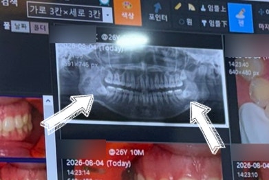 매복 사랑니 발치 후기 / 통증, 붓기, 주의사항