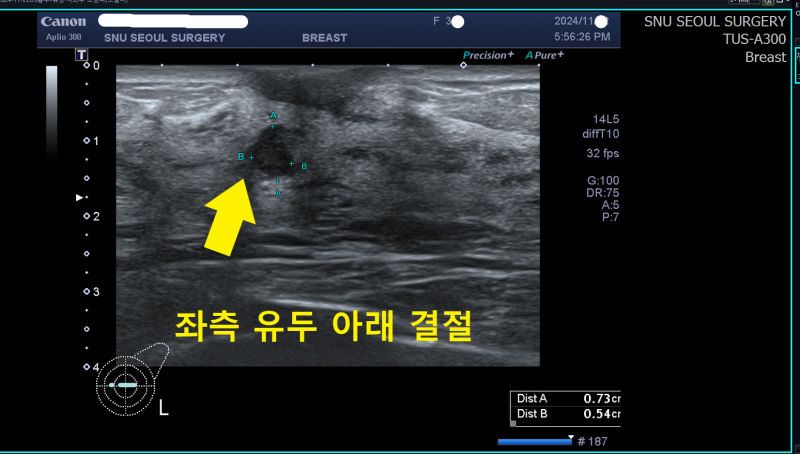섬유선종 진단 결절 맘모톰유방양성종양절제술로 비정형유관증식증 찾아낸 사례 ;; SNU서울....