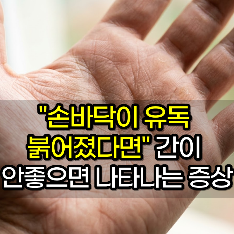 "손바닥이 유독 붉어졌다면" 간이 안좋으면 나타나는 증상 5가지