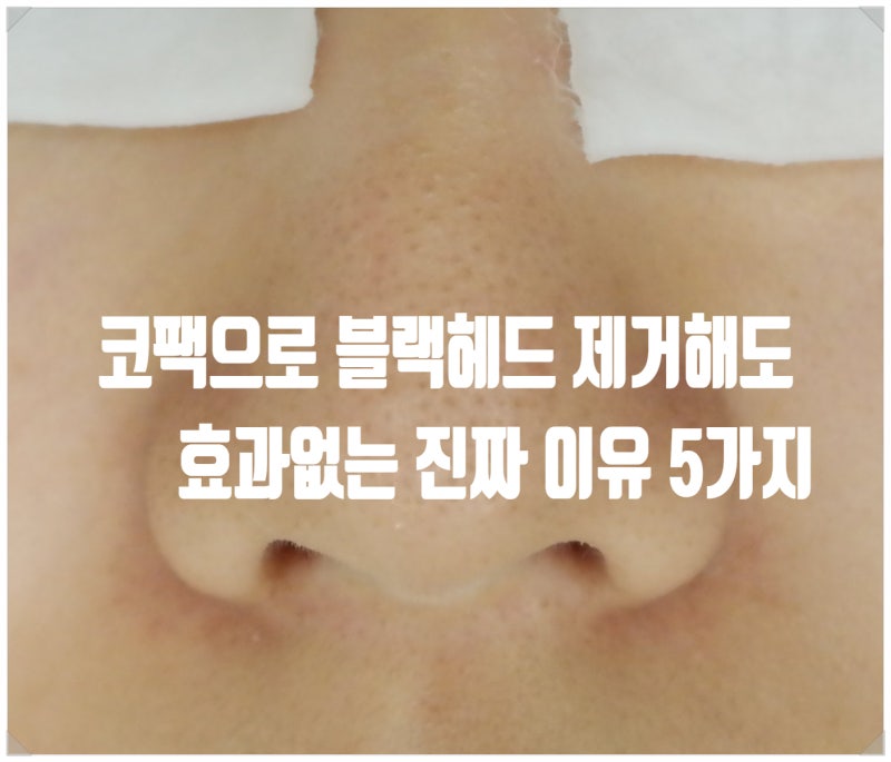 코팩으로 블랙헤드 제거해도 효과없는 진짜 이유 5가지