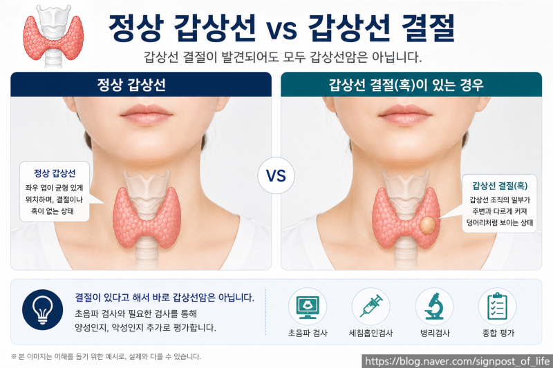 갑상선암 시리즈 2편 갑상선 결절이 발견되면 암일까? 초음파부터 세침검사까지