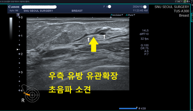 우측 유두 아래 유관 확장 소견 결절, 유방조직검사 및 맘모톰으로 제거한 관내유두종 사례