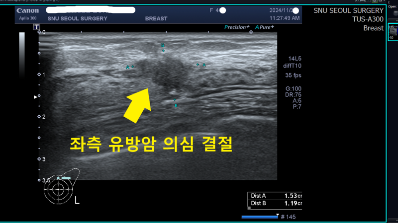 건강검진 좌측 유방 결절, 당일 유방조직검사로 발견한 2cm 유방암 사례 ;; 강동구유방외과