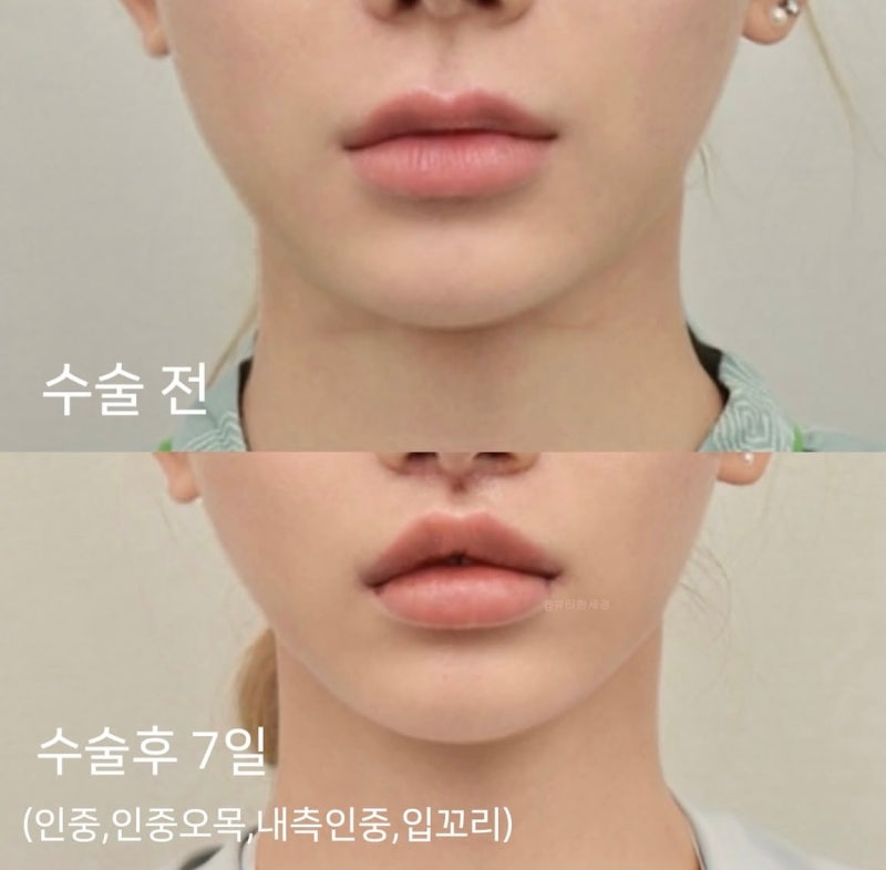 맹승지 인중 성형 인중축소술 뭐길래? 이지혜도 했다고..