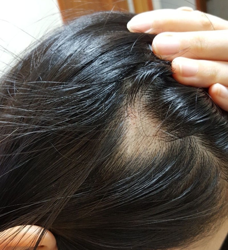 20대 30대 여자 원형탈모 극복기