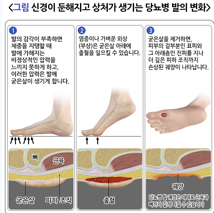 갑자기 발에 상처가 낫지 않는다면 당뇨병성 족부병증 원인 및 예방 관리 방법