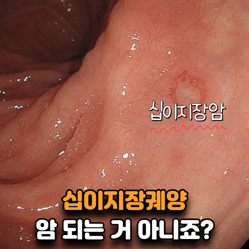 “십이지장궤양 있으면 암 되는 건가요?” 가장 많이 하는 오해