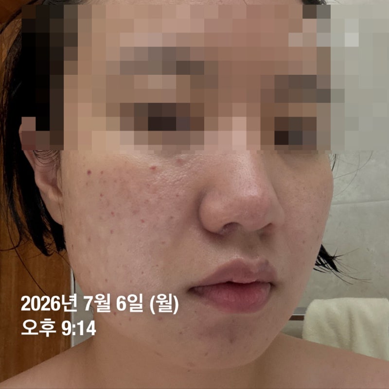 써마지 + 리쥬란HB + 스킨보톡스 / 쌩돈내산 썰: 3편 (1~6일차 후기 및 효과, 엠보, 부작용, 멍 자....