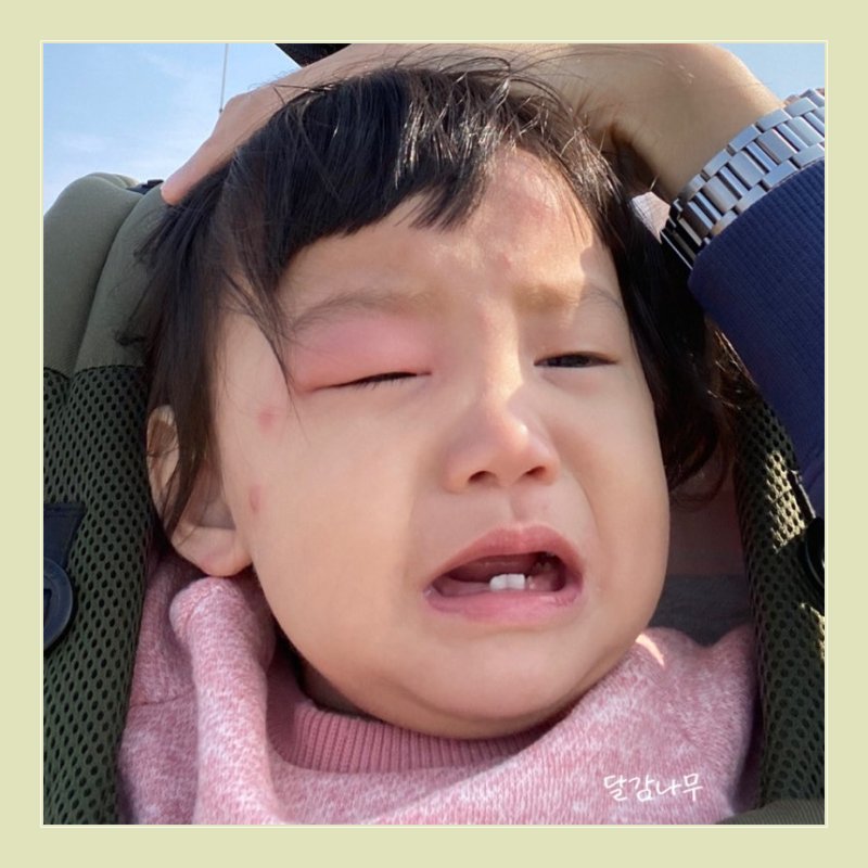 모기 알레르기 스키터 증후군은 없어질까? 아기 모기 물렸을때 모기약
