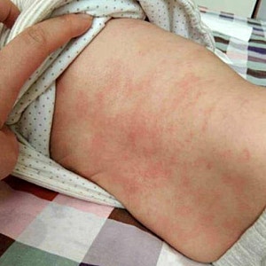아기 땀띠 비판텐 연고 효과 순한 크림과 시너지 무엇?
