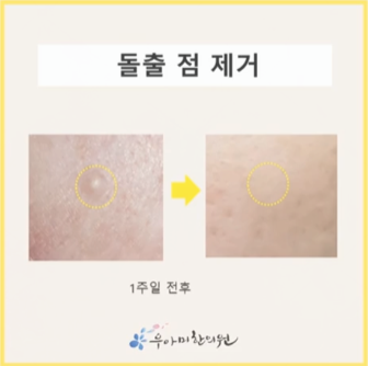 질전정유두종, 여자 콘딜로마를 구별할 때 돌기의 바닥을 봅니다